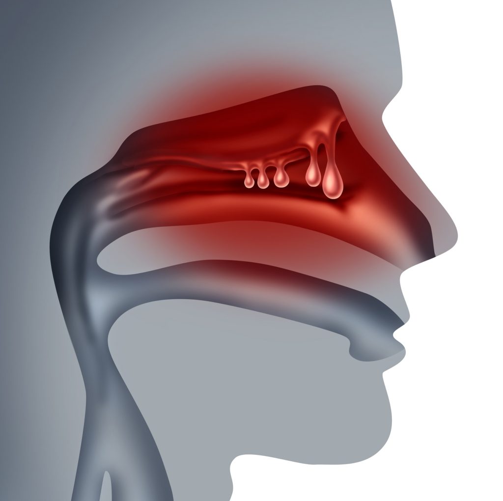 Nasal polyps inside the nasal cavity